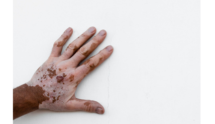 Mamacadela ajuda a tratar o vitiligo