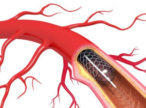 Desobstrução dos vasos sanguíneos