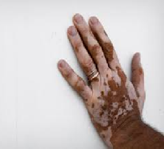 tratar vitiligo