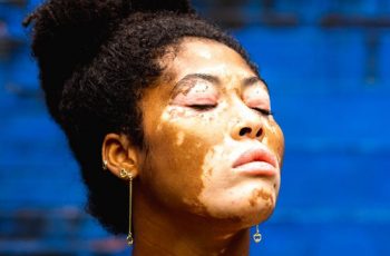 Veja como cuidar da pele com vitiligo em casa